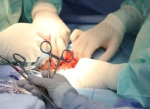 surgical procedure